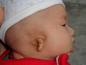 外耳道闭锁原因 外耳道闭锁原因