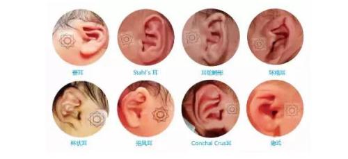 耳廓整形前后的注意事项有哪些