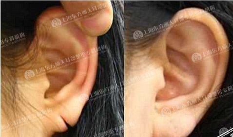 耳垂整形后必知3大注意事项