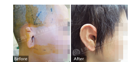 在上海能做好全耳再造的医院是哪家