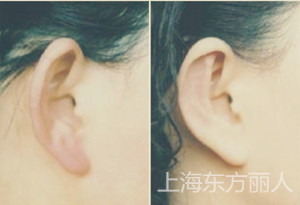 招风耳整形这4大细节你都注意了吗 招风耳整形效果图