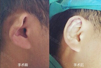招风耳整形 招风耳矫正