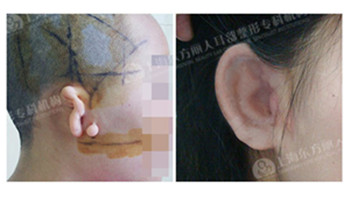 上海东方丽人耳畸形矫正 东方丽人全耳再造术