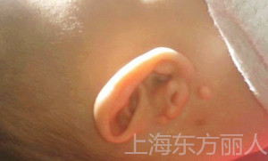 附耳特征 什么是附耳