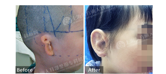 上海耳廓整形安全吗