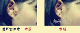 附耳切除术