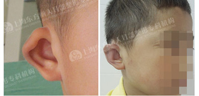 杯状耳矫正 杯状耳整形