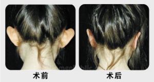 招风耳修复手术