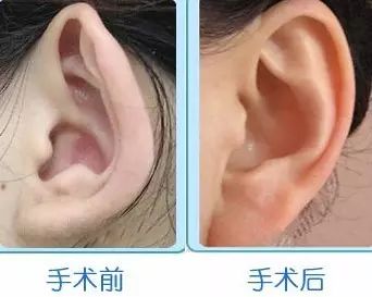 招风耳整形